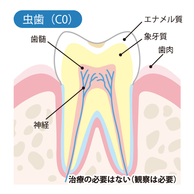 安佐北区亀山(広島市)の歯医者、かわばたファミリー歯科のなるべく削らず、痛くない治療
