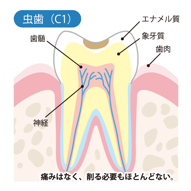 安佐北区亀山(広島市)の歯医者、かわばたファミリー歯科のなるべく削らず、痛くない治療