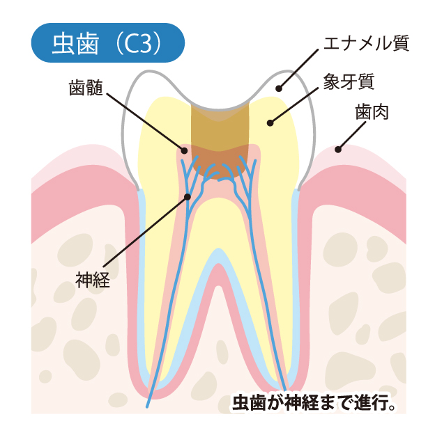 安佐北区亀山(広島市)の歯医者、かわばたファミリー歯科のなるべく削らず、痛くない治療