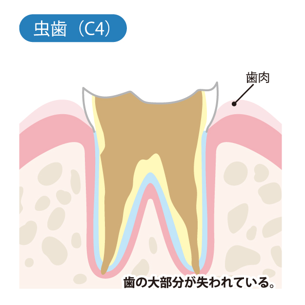 安佐北区亀山(広島市)の歯医者、かわばたファミリー歯科のなるべく削らず、痛くない治療