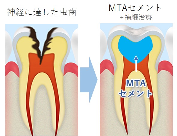 安佐北区亀山(広島市)の歯医者、かわばたファミリー歯科の削らず、痛くなく、歯を残す治療