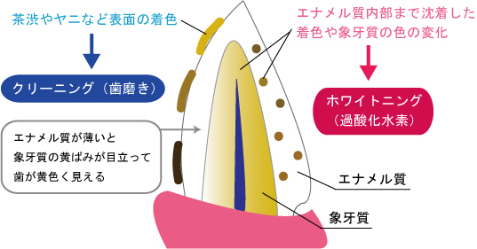 安佐北区亀山(広島市)の歯医者、かわばたファミリー歯科のホワイトニング